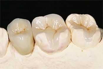 Bild von Kiefermodell mit stabilen individuell angefertigten Keramikinlays - Ästhetische Zahnheilkunde Zahnarzt Dr. Weitze Hamburg