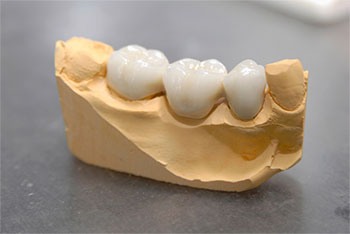 Bild festsitzender metallfreier vollkeramischer Zahnersatz in Zahnkiefer - Ästhetische Zahnheilkunde Zahnarzt Dr. Weitze Hamburg