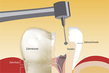 Grafik eines aufgebohrten Zahns, Techniken der endodontischen Behandlung - Dr. Weitze, Endodontie Hamburg