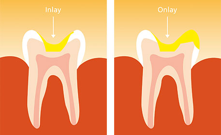 Grafik von Keramikfüllungen als Inlay und Onlay, eingeklebt an den Zahn - Füllungstherapie Zahnarzt Dr. Weitze Hamburg