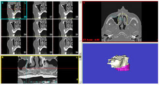 Digitales Bild von3D Implantatplanung zur Vermeidung von Risiken bei der Implantation - Dental Hightech Zahnarzt Dr. Weitze Hamburg