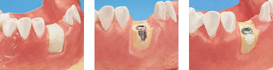 Bild zum Knochenaufbau (Augmentation) für Zahnimplantate - Dr. Weitze Implantologie Hamburg