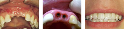 Frontzahnlücke - Zahnverlust durch Unfall und Ersatz durch 2 XIVE- Implantate