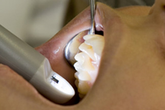 Bild einer modernen Intraoralkamera für Farbaufnahmen von Zähnen zur Diagnostik - Dental Hightech Zahnarzt Dr. Weitze Hamburg