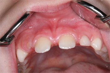 Bild von geöffnetem Mund mit eingewachsenem Lippenbändchen - Kieferchirurgie Dr. Weitze Hamburg